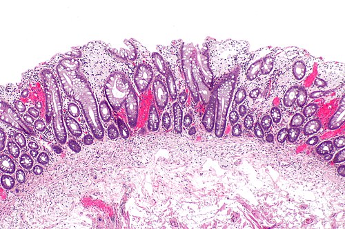 Xanthomatous polyp -- low mag.jpg