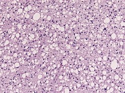 Astrocytoma whoII HE.jpg