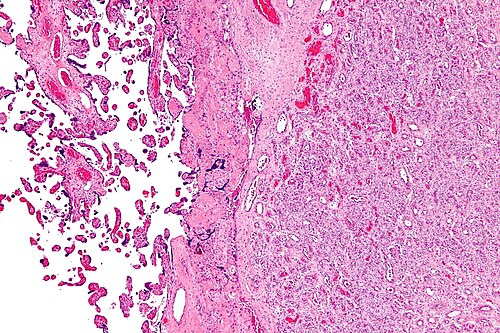 Chorangioma - low mag.jpg