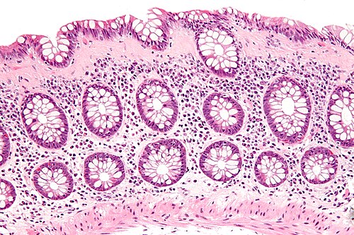 Collagenous colitis - high mag.jpg