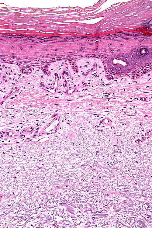Solar elastosis - high mag.jpg