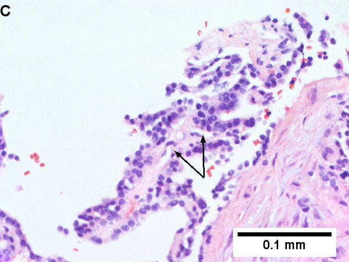 Metastatic thyroid carcinoma to liver