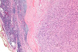 Intranodal palisaded myofibroblastoma - low mag.jpg