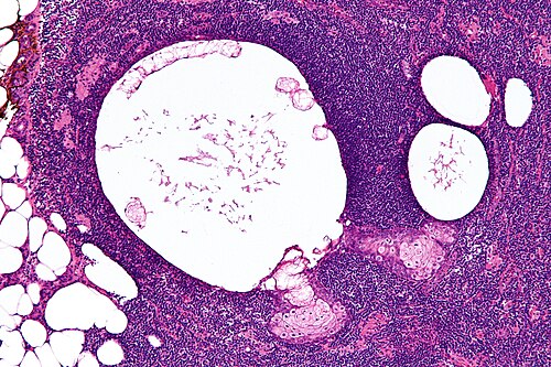 Sebaceous lymphadenoma - intermed mag.jpg
