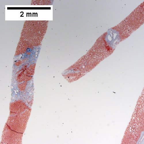 Trichrome shows fibrous spaces with dilated ducts (20X).