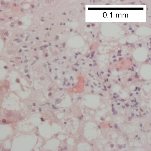 Lipogranuloma (400X).