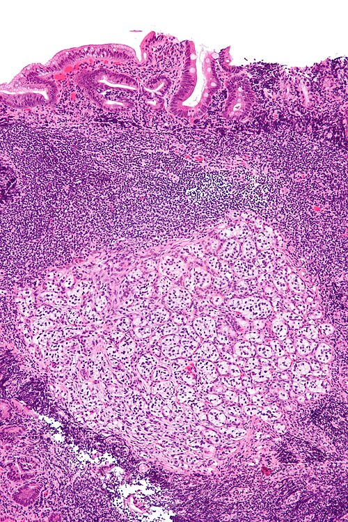 Paraganglioma - intermed mag.jpg