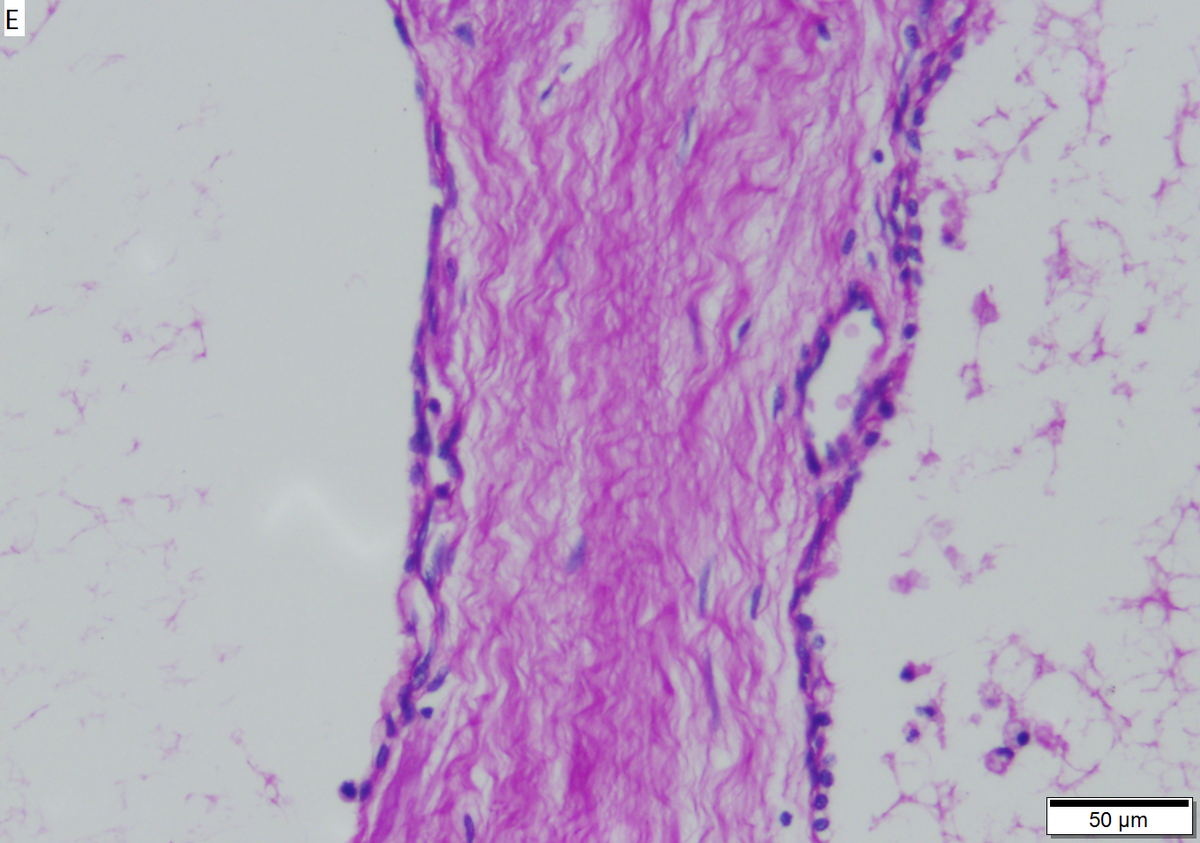 Microcystic serous cystadenoma of pancreas