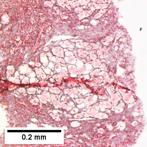 Reticulin shows regeneration (two nuclei per cord) in a nodule, but not throughout (Row 2 Right 200X).