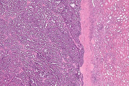Metanephric adenoma - low mag.jpg