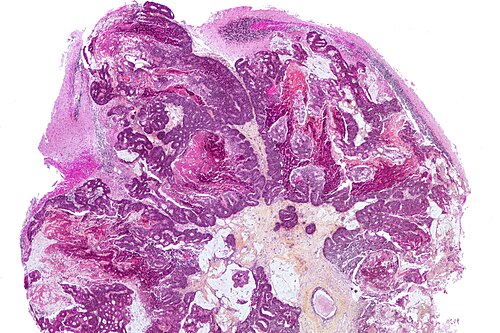 Metastatic adenocarcinoma - cerebellum - very low mag.jpg