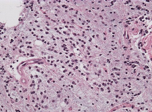 Neuropathology case DOLN HE III.jpg