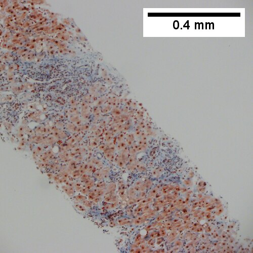 Trichrome shows space of Disse collagenization and periportal fibrosis without definite bridging (100X)..