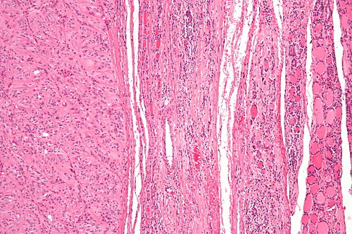 Hyalinized trabecular tumour - intermed mag.jpg