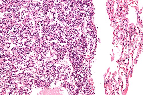 Lung carcinoid - high mag.jpg