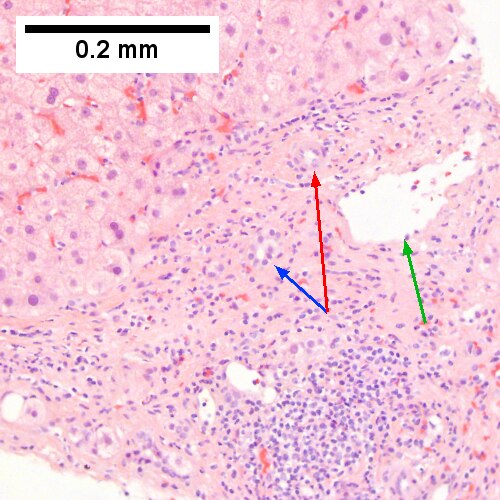 Alcoholic hepatitis with Metavir stage IV fibrosis (advanced fibrosis/cirrhosis).