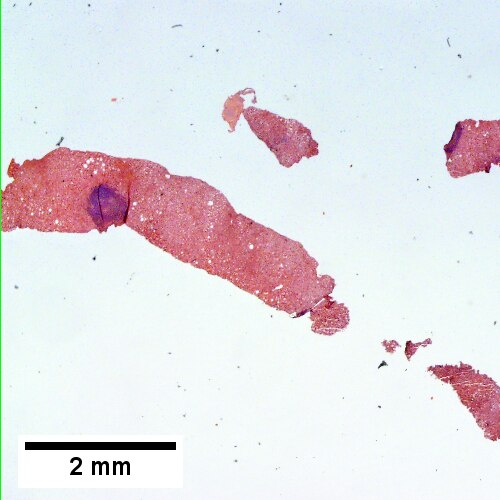 Two inflamed triads accompany acini with mild steatosis (20X).