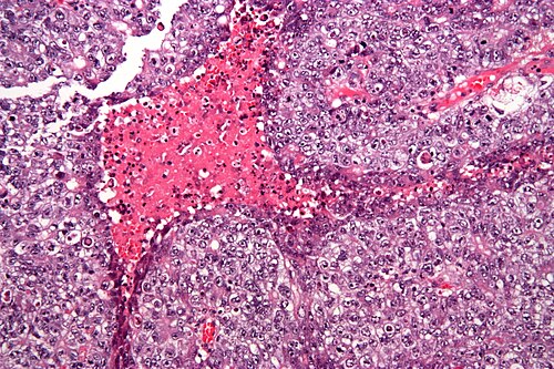 Embryonal carcinoma - high mag.jpg