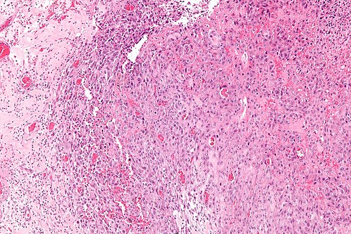 Epithelioid sarcoma - intermed mag.jpg