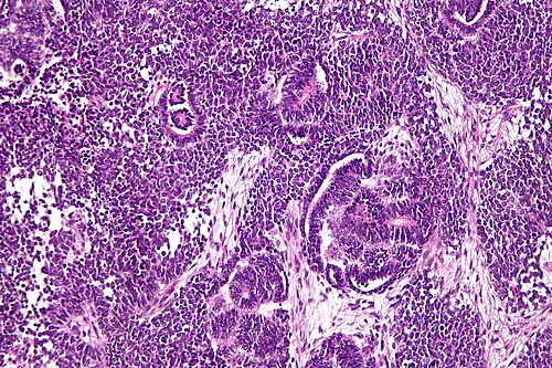 Wilms tumour - high mag.jpg