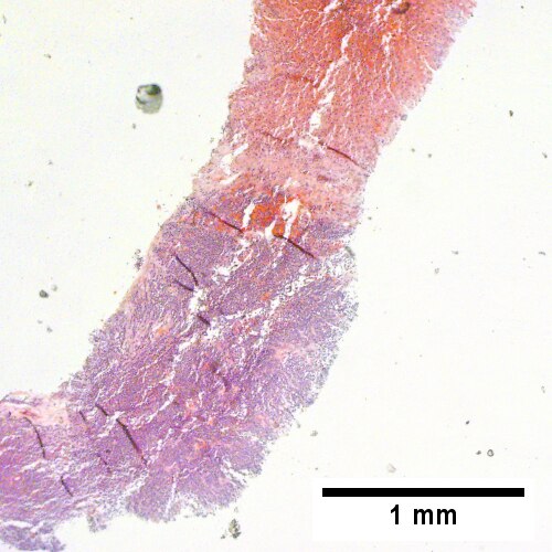 The other core showed a mass of tumor mashed against normal liver (Row 2 Left 40X).