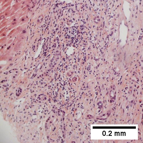 Surrounding tract with tortuous bile ducts & inflammation, likely secondary to hamartomas (200X).