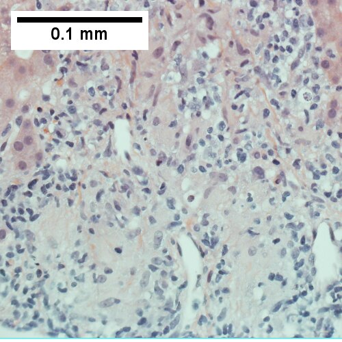 Loose granuloma (400X).
