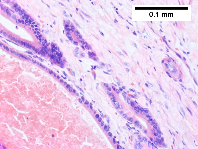 Intraductal papillary neoplasm of common bile duct with associated invasive carcinoma.