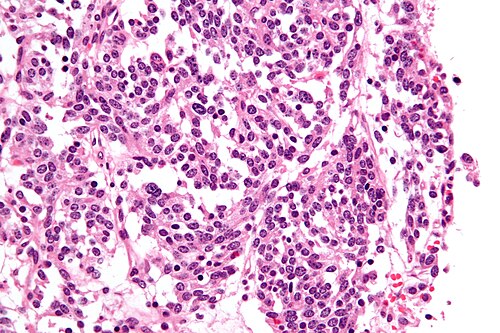 Lung carcinoid - very high mag.jpg