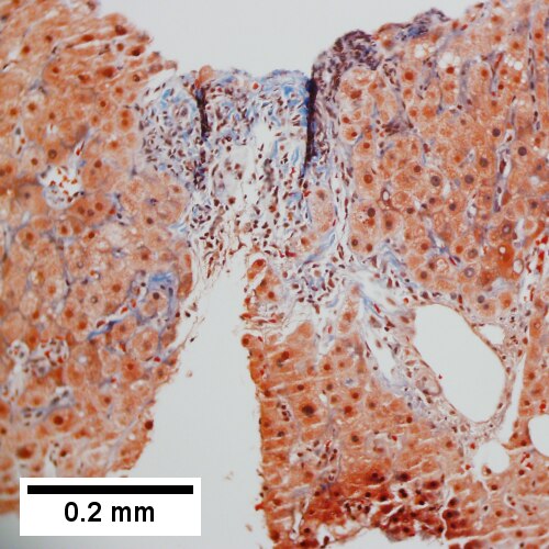 Trichrome of the same triad shows portal fibrosis (200X).