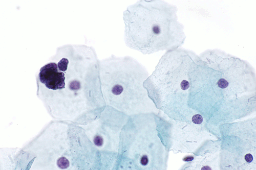 Endometrial cells on Pap - 2 -- very high mag.gif