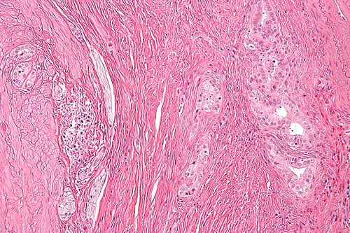Vasitis nodosa -12- high mag.jpg