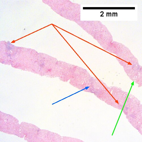 Hepatitis C. Metavir Activity Index 2 (PMN2, LN1), Metavir fibrosis stage 3