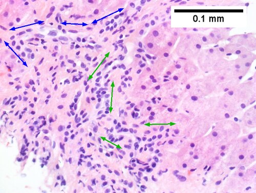 Cirrhosis in an alcoholic.