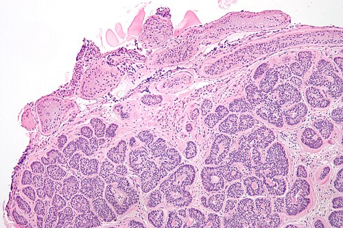 Sertoli cell nodule low mag.jpg