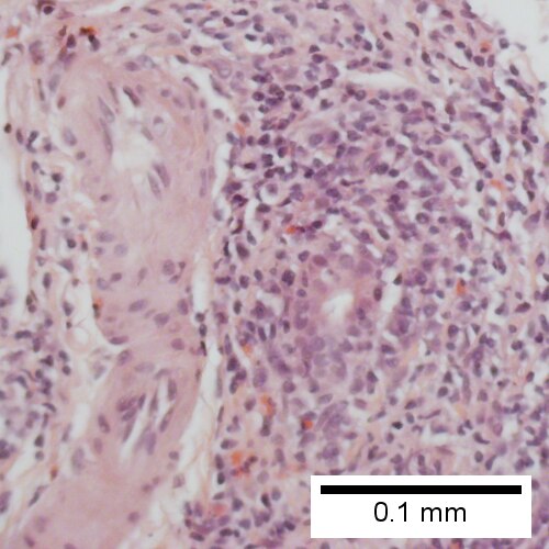 Florid duct lesion (Row 2 Left 400X).