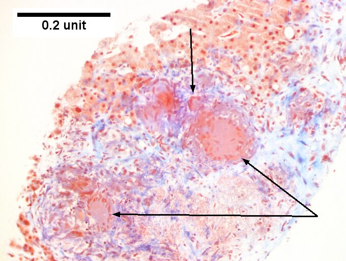 Hepatic sarcoidosis in a patient with previously known sarcoidosis.