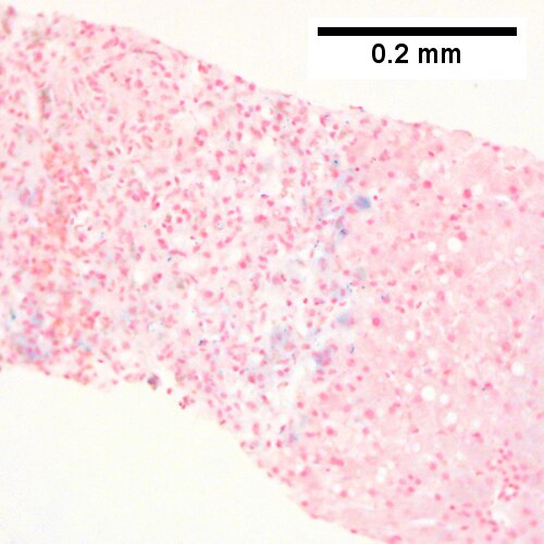 Submassive hepatic necrosis.