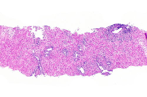 Prostate with radiation changes -- low mag.jpg