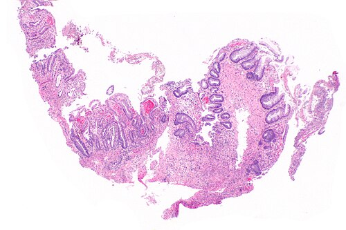 Radiation proctitis -- very low mag.jpg