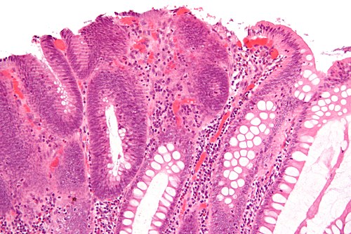 Tubular adenoma 2 high mag.jpg