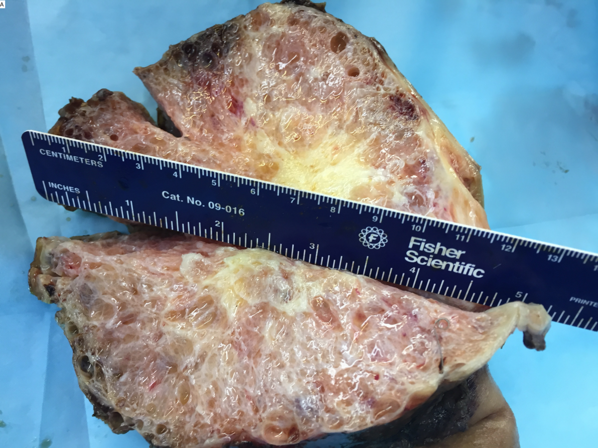 Microcystic serous cystadenoma of pancreas