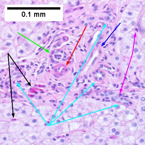 Steatohepatitis. Brunt necroinflammatory grade 2. Brunt fibrosis stage 2.