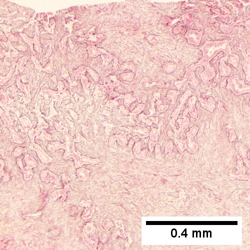 Cholangiocarcinoma, intrahepatic, large duct type.