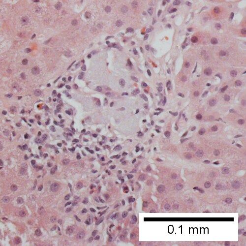 Granuloma in portal triad (Row 1 Right 400X).