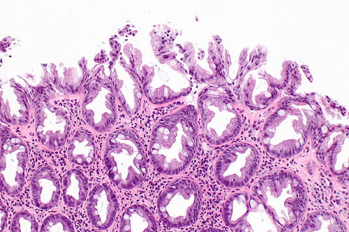 Hyperplastic polyp -- intermed mag.jpg