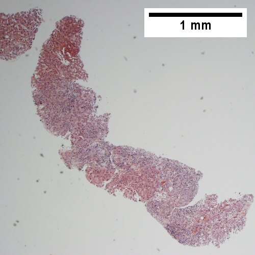 Ill defined triads, inflamed lobule (40X).