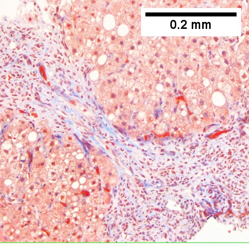 Hepatitis C. Metavir Activity Index 2 (PMN2, LN1), Metavir fibrosis stage 3