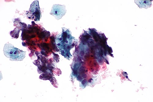 Atypical squamous cell of undetermined significance - 1a -- high mag.jpg