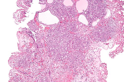 Nephrogenic adenoma - low mag.jpg